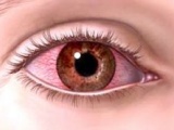 Как лечить покраснение глаз