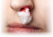 Первая помощь при кровотечении из носа